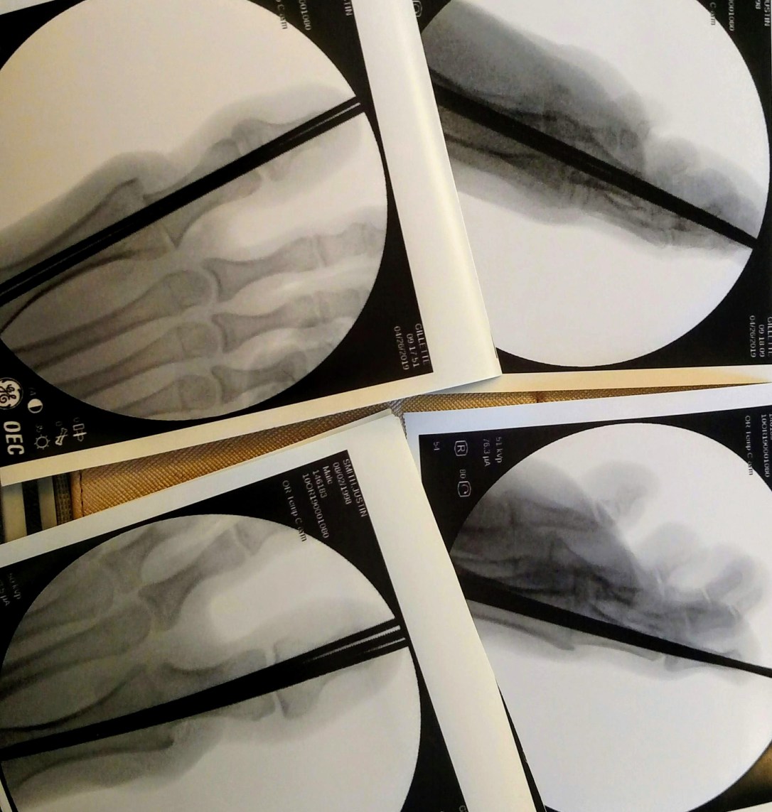 Photo of X-rays showing pins through right and left big toes