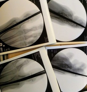 Photo of X-rays showing pins through right and left big toes