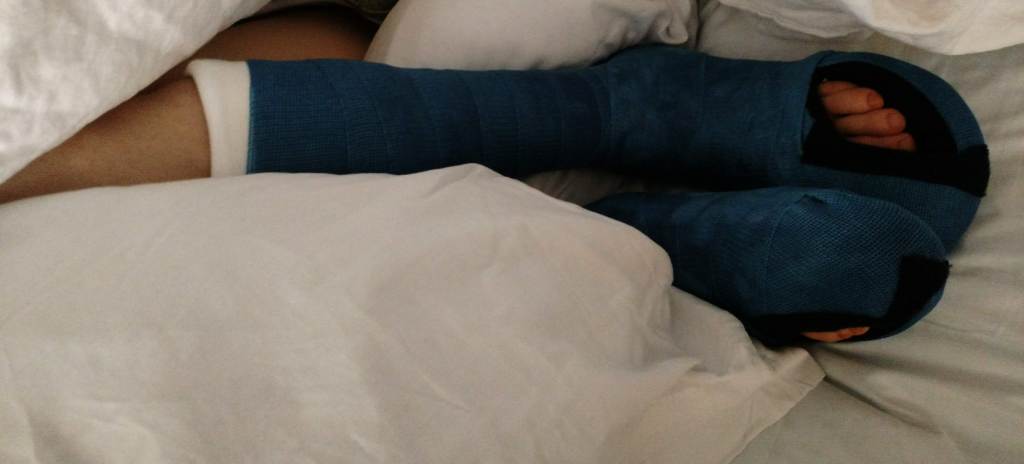 legs with 2 blue 1/2 leg casts