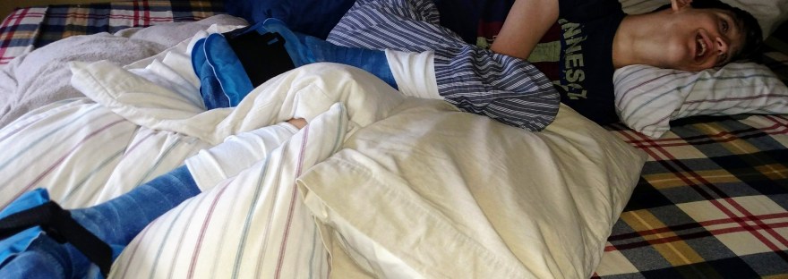 Smiling Justin laying on bed with casts on each leg propped up on pillows